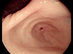 Magenantrum und Pförtner