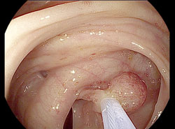 Polyp in der Schlinge